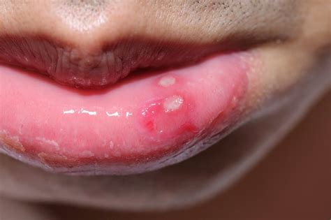 What Causes Sores Inside Lips