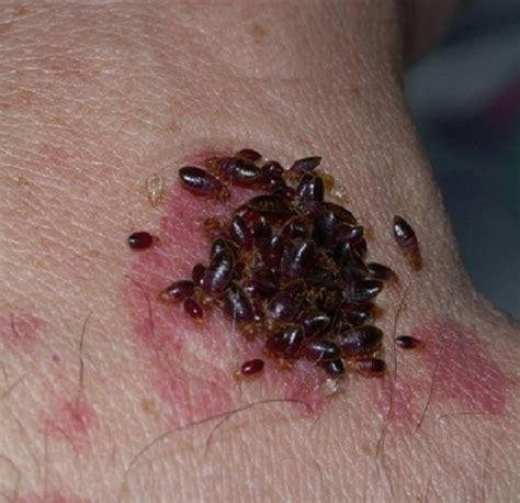 Bed Bug Bites Pictures On Babies