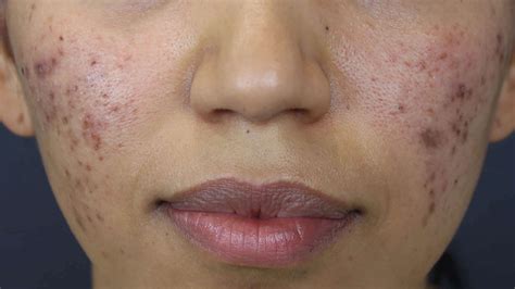 Acne And Congestion Treatment The Face Bar Laser Clinic Darlinghurst Sydney