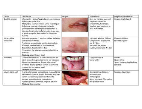 Lesiones De La Mucosa Oral Lesión Descripción Imagen Tratamiento