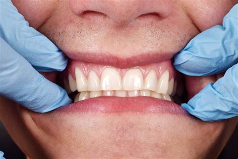 What Should Healthy Gums Look Like Hoffman Dental Care