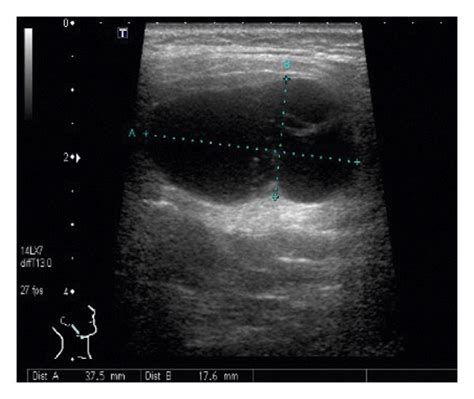 Ultrasonography Of The Right Parotid Gland Revealed A Download