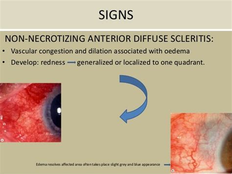 Episcleritis And Scleritis Ophthalmology