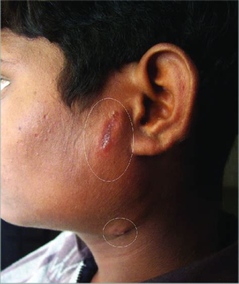 Photograph Showing Parotid Swelling And Draining Sinus In A Patient