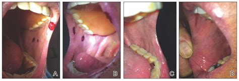 Heparin Induced Bullous Hemorrhagic Dermatosis Confined To The Oral