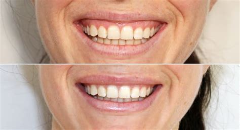Maybe you would like to learn more about one of these? Gummy Smile Correction with Botox Injections Santa Barbara ...