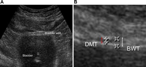 A Ultrasonography To Measure The Thickness Of Detrusor Muscle And