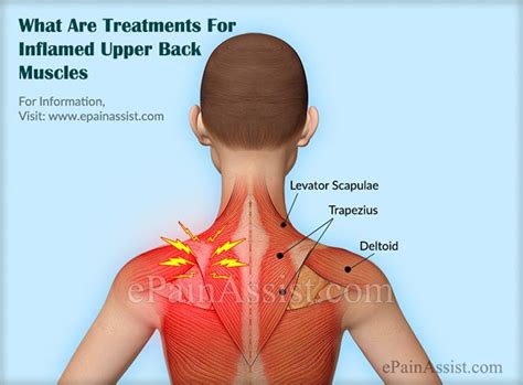 Inflamed Upper Back Muscles Treatment Causes Symptoms