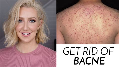 How To Get Rid Of Bacne Sharon Farrell Bacne Sharon Farrell Acne