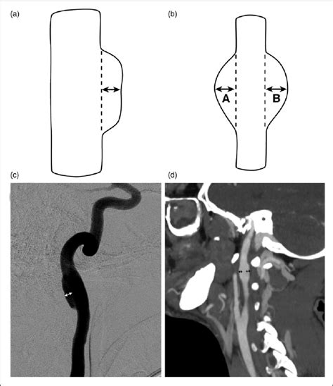 Fusiform Traumatic Aneurysm A Broad Based Spindle Shaped Or
