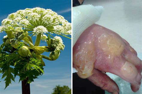 Giant Hogweed Warning Weed Leaves Horrifying Burns And Blisters