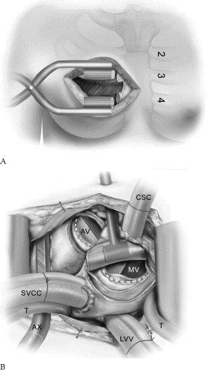 Port Access Approach For Combined Aortic And Mitral Valve Surgery The