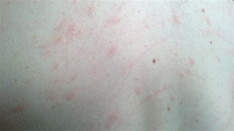 Itchy Red Bumps On Stomach And Back What Are These Babycenter