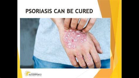 Psoriasis Can Be Cured Vitamin D Megatherapy And Ozone Therapy World