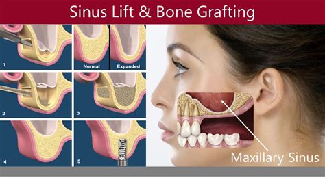 What Is A Sinus Lift For Dental Implants Miltonoakvillemississaugaburlington