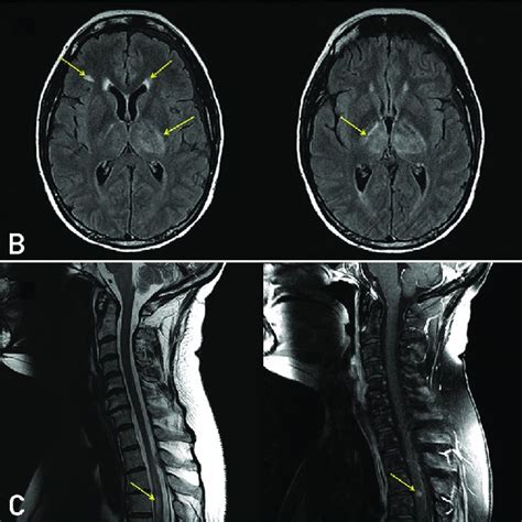 A Coronal T2fs Left And T1fs Right Postgadolinium Mri Images Of