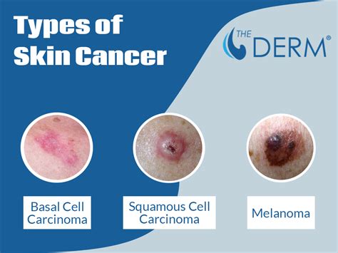 Skin Cancer Screening The Derm Dermatologists In Cook County Il