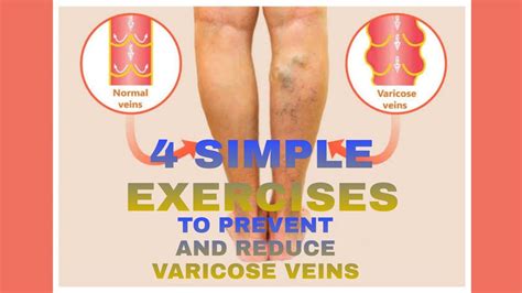 4 Simple Exercises To Prevent Varicose Veins Youtube