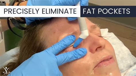 WATCH An Agnes Treatment For Under Eye Bags YouTube