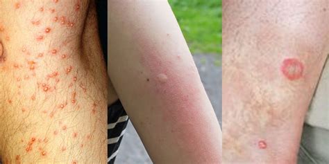 Bed Bug Bites On Legs Sales Cheapest Save 60 Jlcatjgobmx