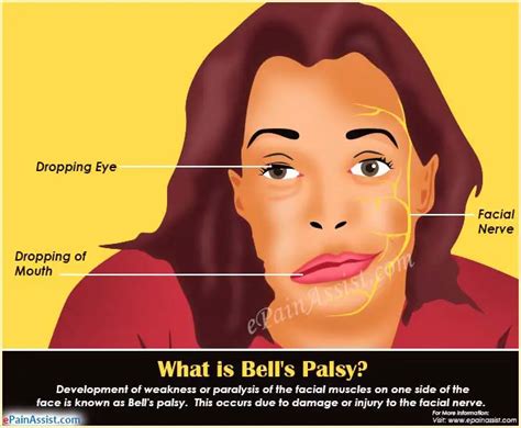 Bells Palsy Causes Signs Symptoms Treatment Diagnosis