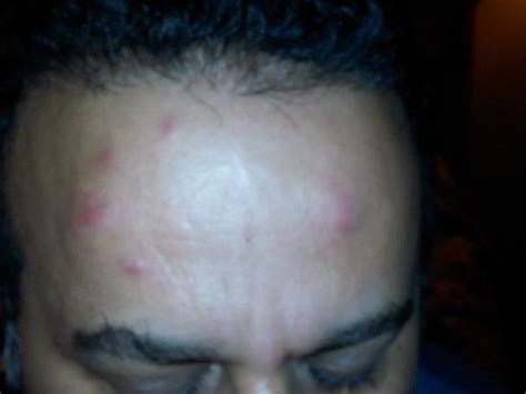 Luxury 50 Of Bed Bug Bite Pictures On Face Phenterminecodp