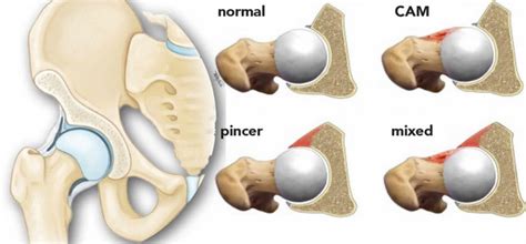 Femoral acetabular impingement causes, symptoms, diagnosis & treatment