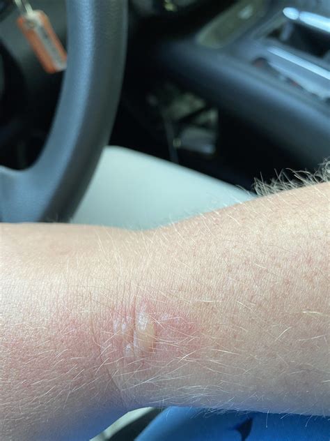Redness And Blister Formed On Wrist Im Not Sure Why This Has Popped