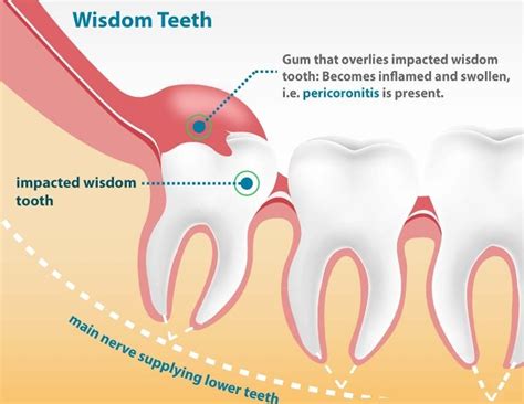 Wisdom Tooth Extraction Impacted Tooth Edinburgh Barron Dental