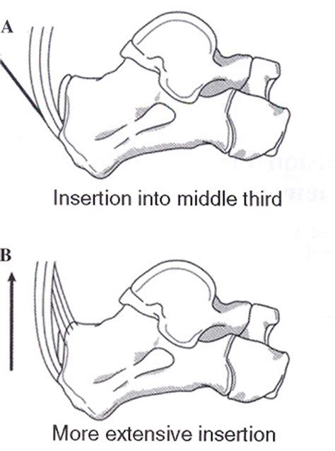 Avulsion Fracture of the Calcaneal Tuberosity: A soft ...