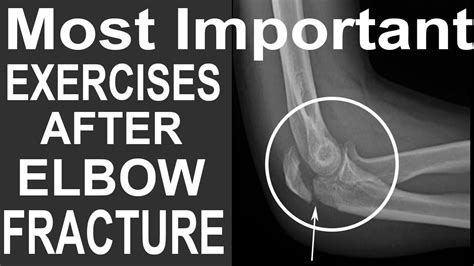 Most Important Exercise After Elbow Fracture Health Made Easy Youtube