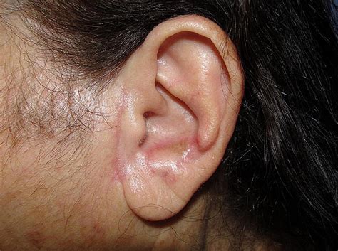 Tunnelised Inferiorly Based Preauricular Flap Repair Of Antitragus And