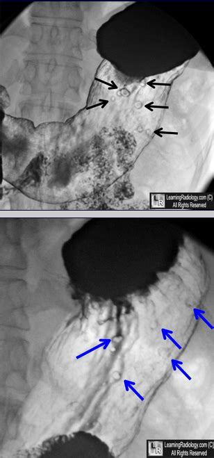 Hyperplastic Gastric Polyps Upper Photo Black Arrows Point To