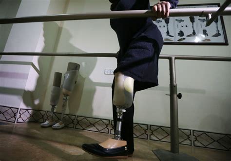 woman decides to have her leg amputated years after snapping it in a freak accident tech times