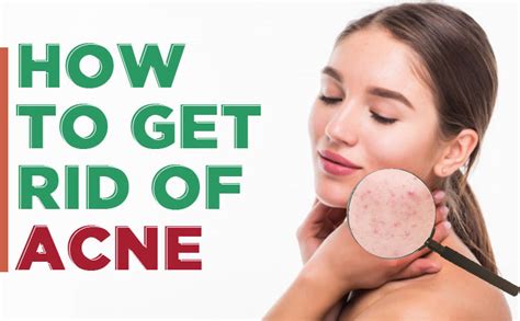 How To Get Rid Of Acne 8 Home Remedies For Smooth Skin