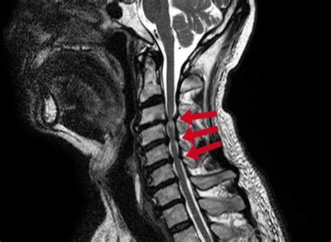 Diagnosis Of Spinal Stenosis Pt Master Guide