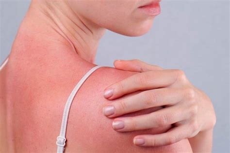 15 Home Remedies For Sun Poisoning For Quicker Relief