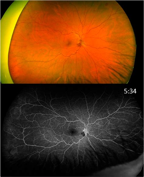 Widefield Color Fundus Photo And Fluorescein Angiography Of The Right
