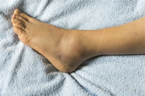 What Causes Left Foot To Swell