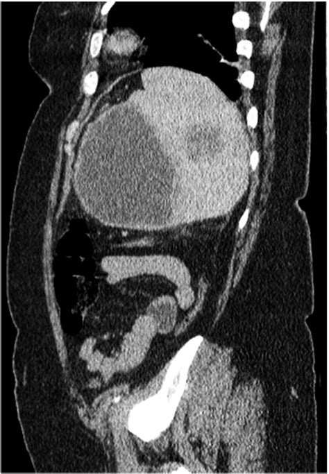 Sagittal Ct Scan Showing Massive Splenomegaly And Splenic Hypodense