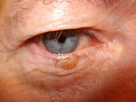 Eyelid Lumps And Lesions The Bmj