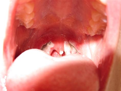Day By Day Tonsillectomy Photos