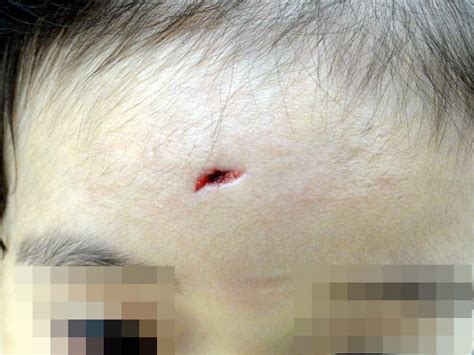 症例27：小児の額の傷 | つかもと内科