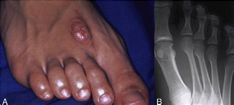A Photograph Of The Right Dorsal Forefoot A Tumor Like Swelling Is