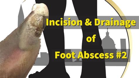 Incision And Drainage Of Foot Abscess 2 Youtube
