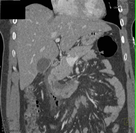 Acute Pancreatitis And Focal Perforation Of Duodenum Following An