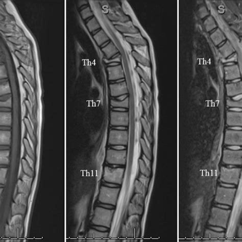 Standing Spinal X Rays Shows A Compression Fracture Of T7 Vertebral