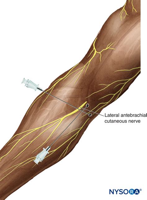 Regional Anesthesia Blocks Of The Lateral And Medial Antebrachial