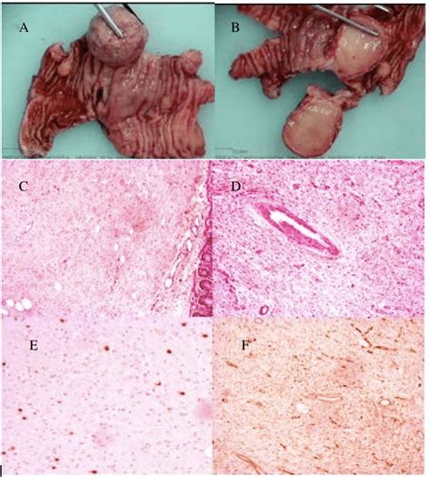 A Gross Multiple Submucosal Inflammatory Fibroid Polyps B Cut