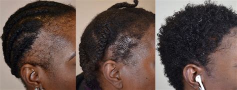 Traction Alopecia Case Study Hair Restoration Of The South